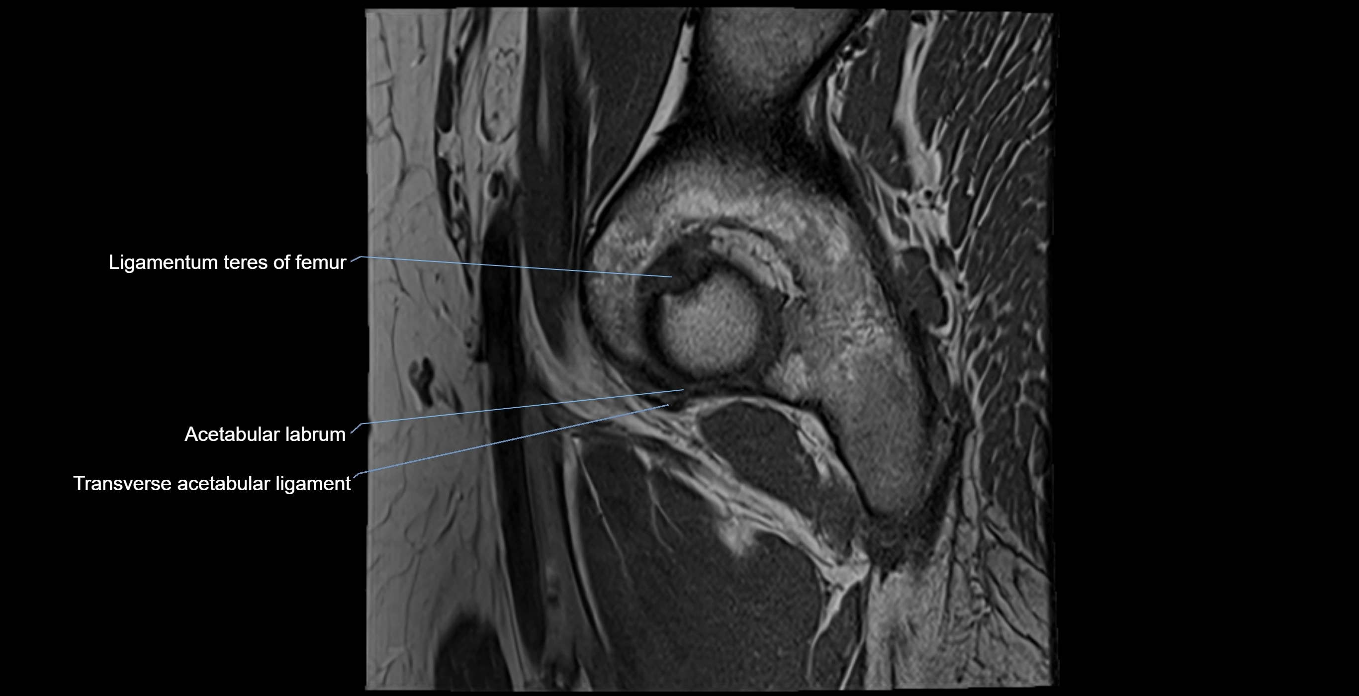 MRI Hip ligaments sagittal cross sectional anatomy 3T  radiology  image-img-00001-00004.webp